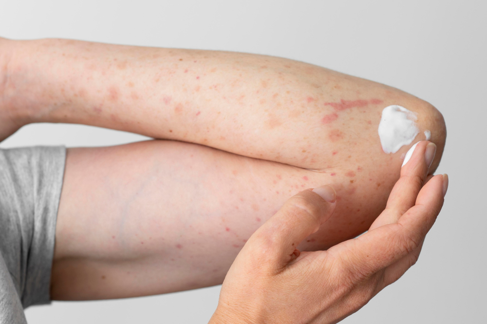 Najczęstsze mity dotyczące atopowego zapalenia skóry